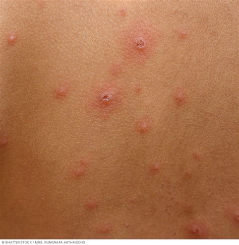 Chickenpox - Symptoms and causes - Mayo Clinic