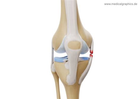 Medial collateral ligament tear - front - MedicalGraphics