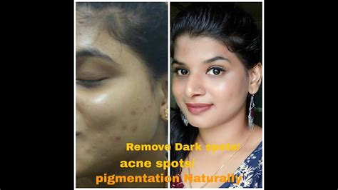 How To Remove Dark Spots Acne Spots And Pigmentation Naturally Youtube