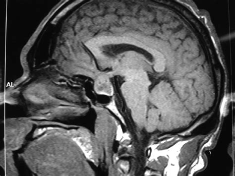 Magnetic Resonance Imaging 1 Showing Pituitary Macroadenoma Download