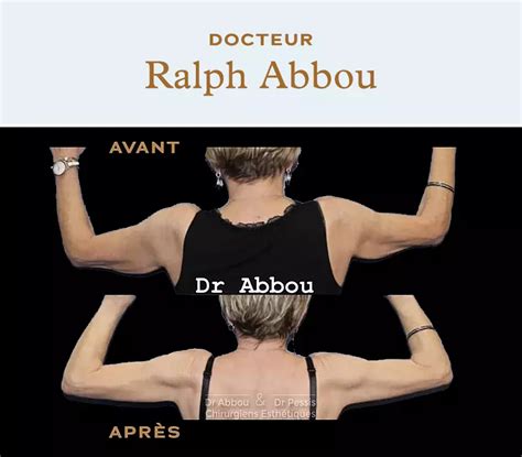 Arm Lift In Paris Dr Abbou And Dr Pessis