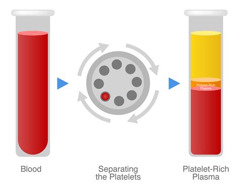 Platelet Rich Plasma Prp Tooth Replacement In Outremont Qc