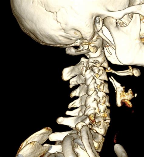 Broken Neck, 3d Ct Scan Photograph by Du Cane Medical Imaging Ltd