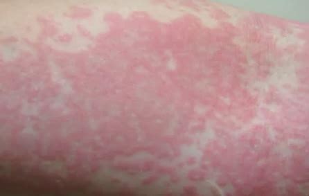 Photodermatitis - Pictures, Treatment, Symptoms, Causes | Health Momma