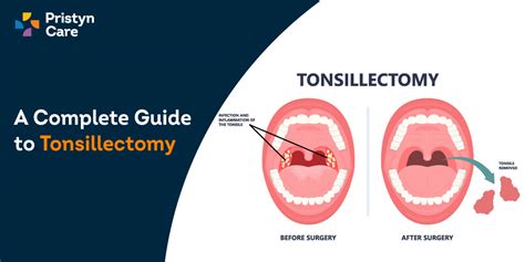 Tonsil Removal After