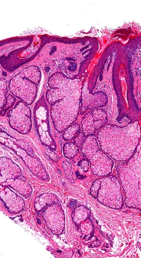 Pathology Of Sebaceous Adenoma Artofit