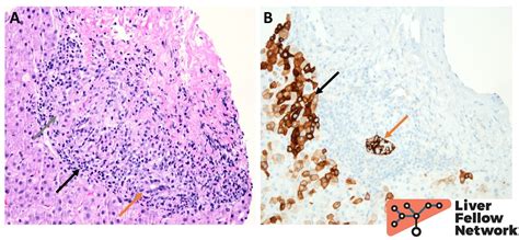 Pathology Pearls: Granulomatous Liver Diseases | AASLD