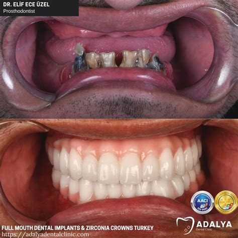 Dentistry Turkey Cosmetic Dentistry Antalya Adalya Dental Clinic