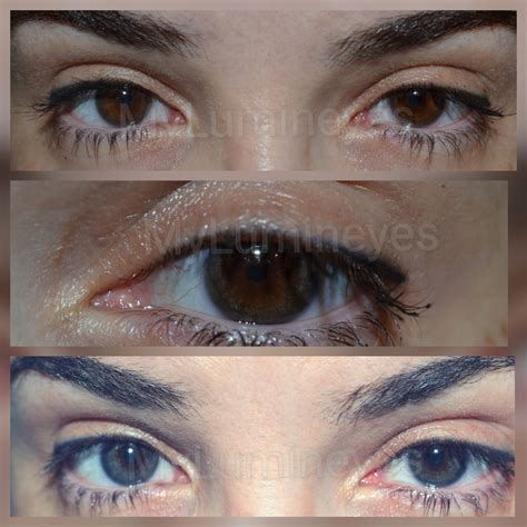 Before And After Photos Of Laser Eye Color Change Surgery