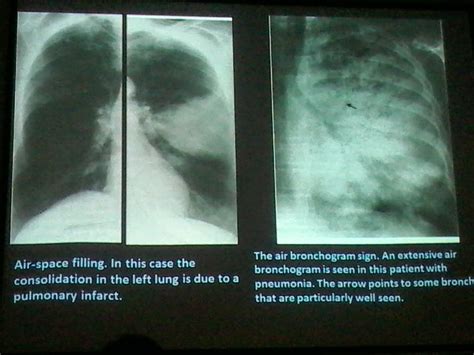 Lecture Slides Radiology Pneumonia Pleural Effusion