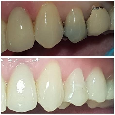 Porcelain Emax Veneers Kensington