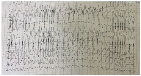 ecg  admission recorded  chaotic rhythm    sinus