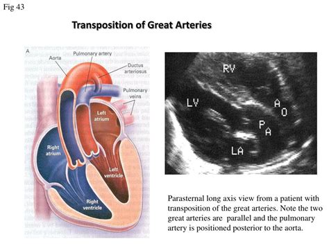 Ppt Transposition Of Great Arteries Powerpoint Presentation Free