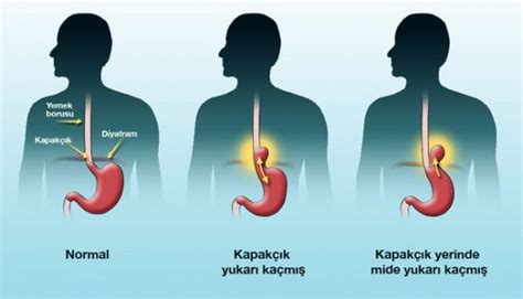 Mide Yanması Nedir Neden Olur Nasıl Geçer Bilgicik