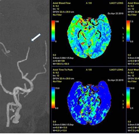 Post Contrast Cerebral Computed Tomography Angiography And Perfusion Download Scientific