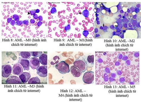 Acute myeloid leukemia (AML): Symptoms, signs | Vinmec