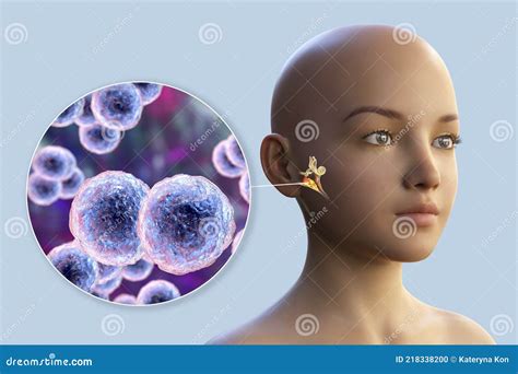 Moraxella Catarrhalis Batterio Come Causa Di Otite Media Illustrazione