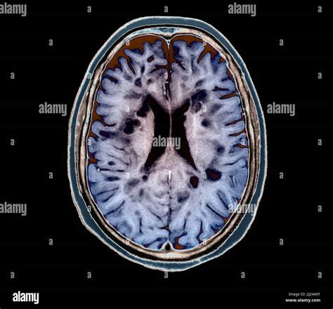 Multiple Sclerosis Mri Scan Stock Photo Alamy