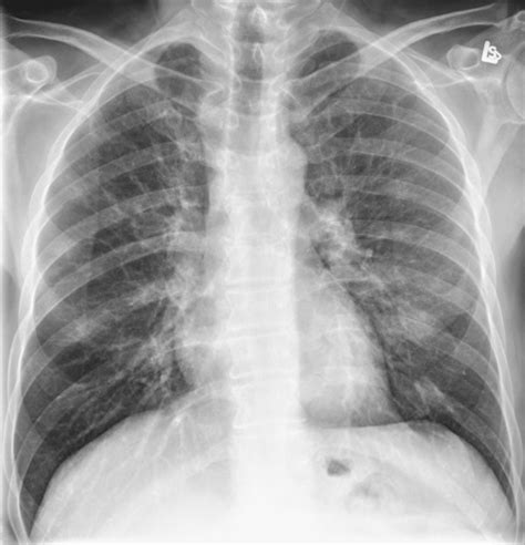 Smoking Related Interstitial Lung Disease Radiology Key