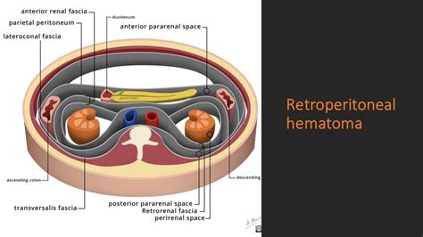 Retroperitoneal Hematoma Nephropocus