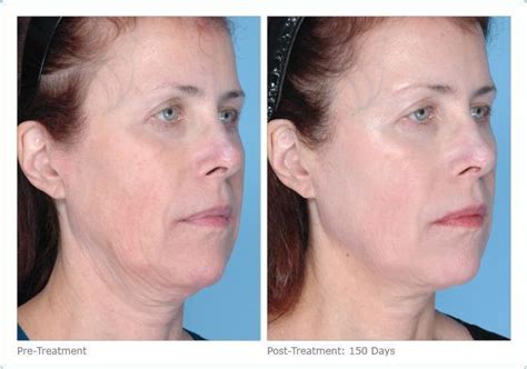 Ultherapy, the Non-Surgical Facelift