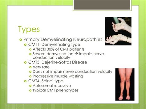 Ppt Charcot Marie Tooth Disease Powerpoint Presentation Free Download Id 3991494