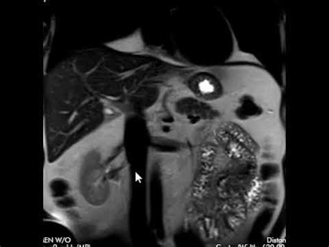 Abdominal Mri Cpt Code With Contrast Unlock Billing Secrets