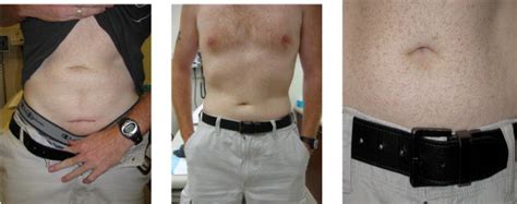 Laparoendoscopic Single-site Pfannenstiel Donor Nephrectomy - Urology