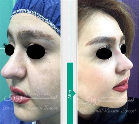 how to fix a bulbous nose tip without surgery