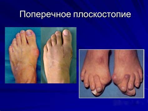 Ортопедические стельки при продольно-поперечном плоскостопии