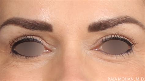 Upper Blepharoplasty Markings Tranetbiologiaufrjbr