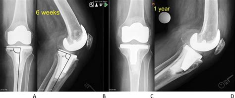 Aseptic Tibial Implant Loosening After Total Knee Arthroplas JAAOS