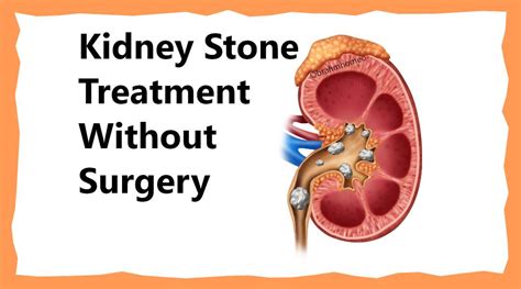 Kidney Stone | Kidney Stone Treatment | Kidney Stone Treatment In ...