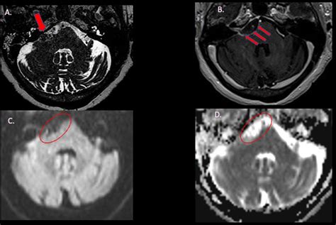 Figure 1 From Intracranial Squamous Cell Carcinoma Of The Cerebello