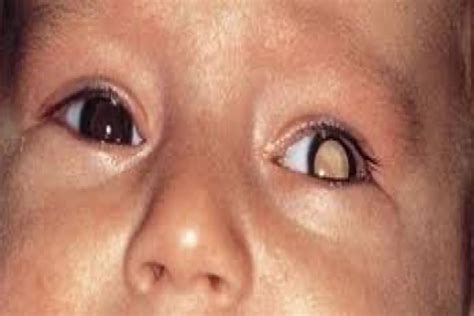 Retinoblastoma En Ojopedia