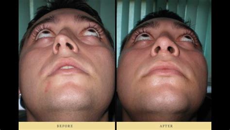 Rhinoplasty & Deviated Nasal Septum surgery for right breath