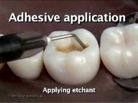 composite class  preparation  restoration youtube