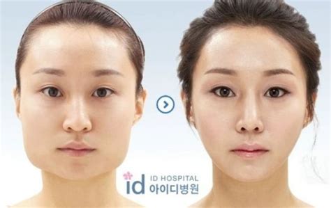 Before And After Photos Of Korean Plastic Surgery Pics Izismile