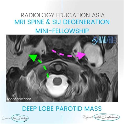 Spine Mri Incidental Findings Radedasia