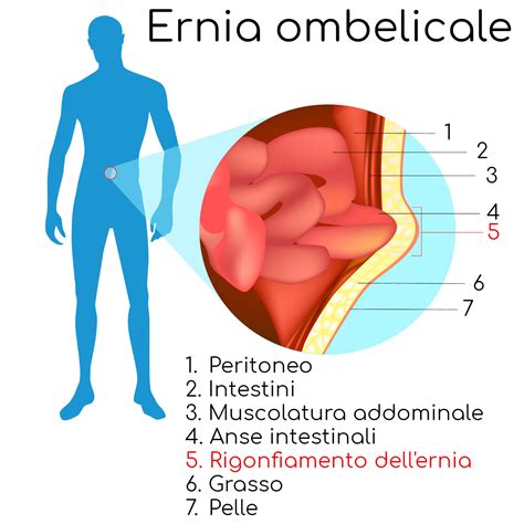 Ernia ombelicale: sintomi, intervento, cause