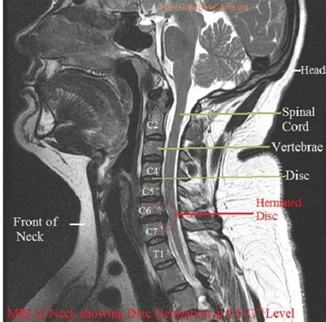 Pinched Nerve In Neck Mri | Hot Sex Picture