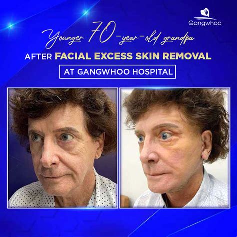 Facial Excess Skin Removal – Bring back your youthful beauty - Gangwhoo ...