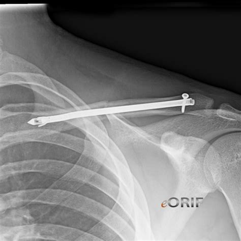 Clavicle Fracture Orif 23515 Eorif