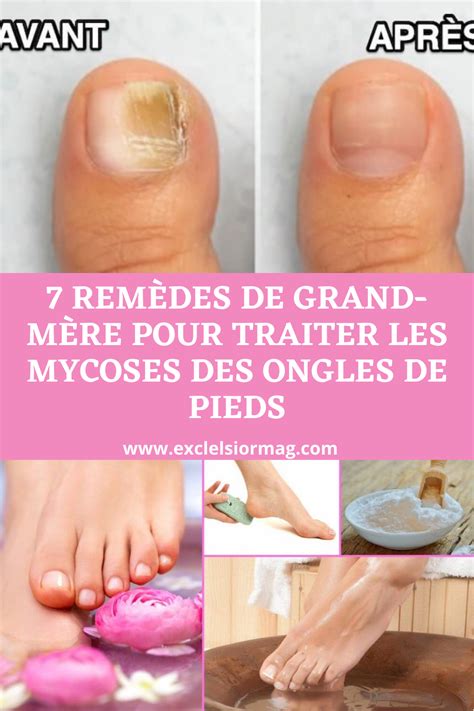 7 remèdes de grand mère pour traiter les mycoses des ongles de pieds