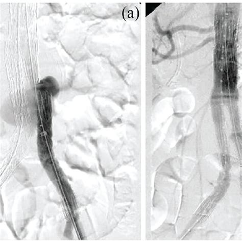 A Aortography Demonstrating The Type Iii Endoleak By Showing Contrast