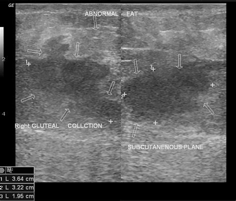 Post Injection Gluteal Abscess Image