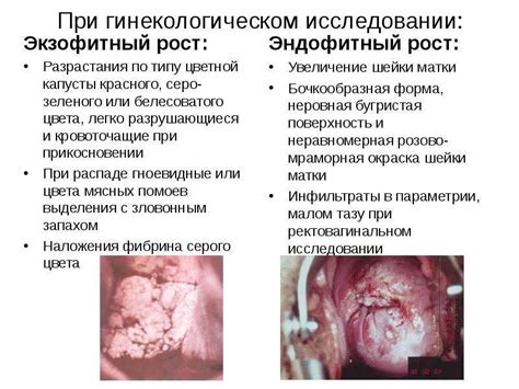 РАК ШЕЙКИ МАТКИ - скачать презентацию