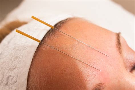 Thin Needles Inserted Into The Body At Acupuncture Points Stock Photo