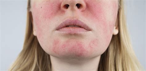 Rosacea Concerns Exeter Skin Southwest