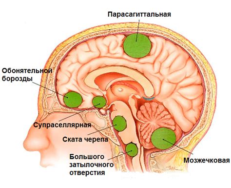 Гемангиома и менингиома в чем разница